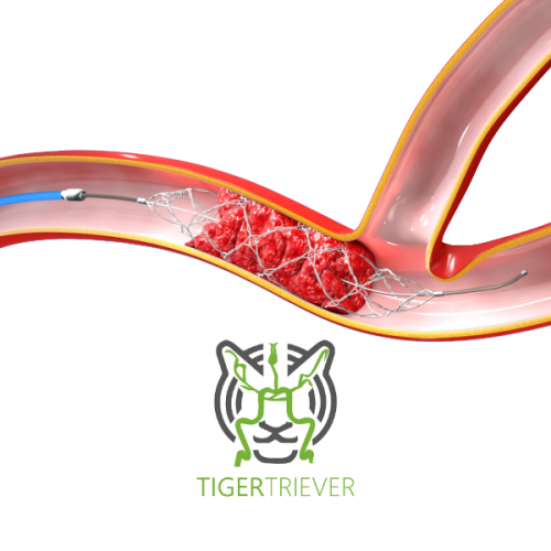 Stent Retriever Tigertriever Rapid Medical Varlix
